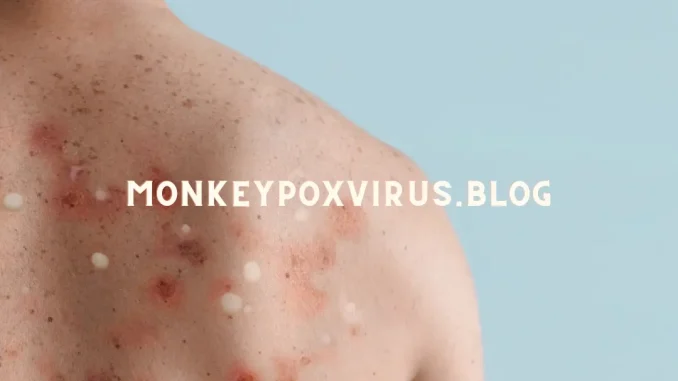 monkeypox mpox virus