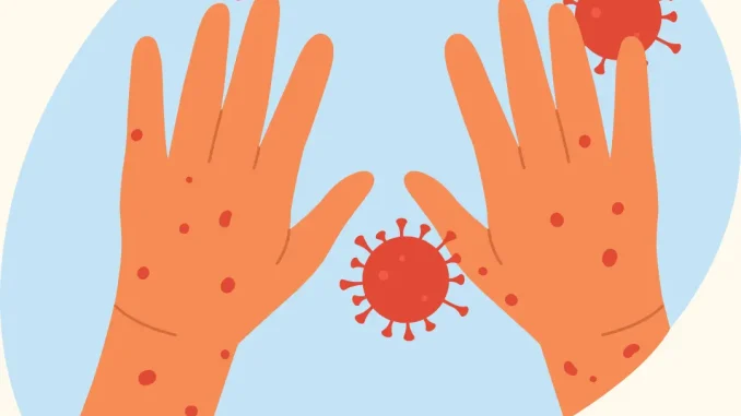 monkeypox mpox virus hands