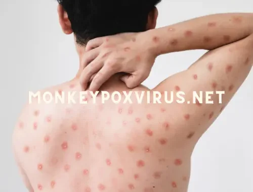 monkeypox virus school close